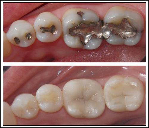 Tooth Fillings - Kians Dental Studio